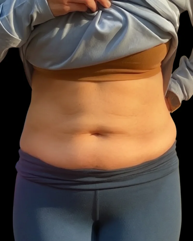 After the BAQ Method, abdomen