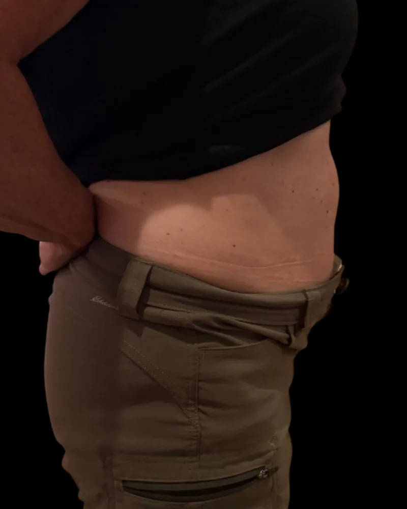Before body sculpting, abdomen