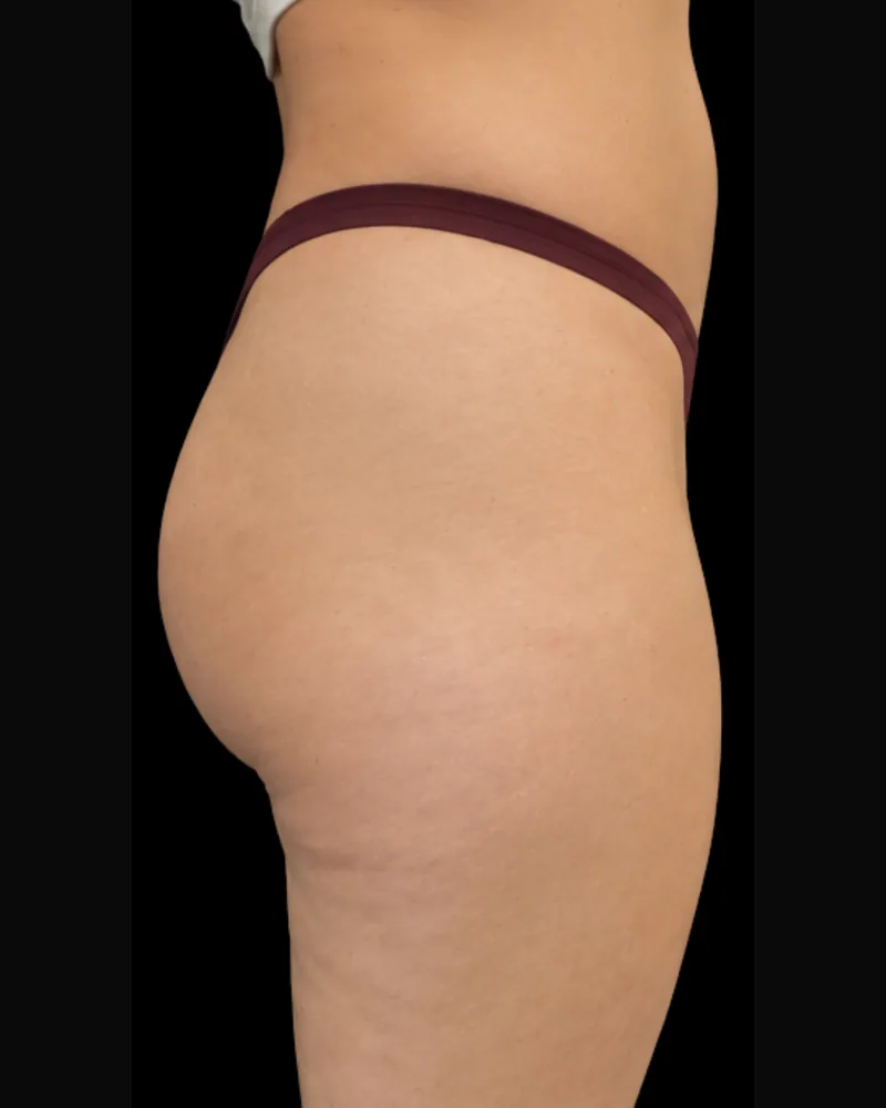 Before body sculpting, glutes
