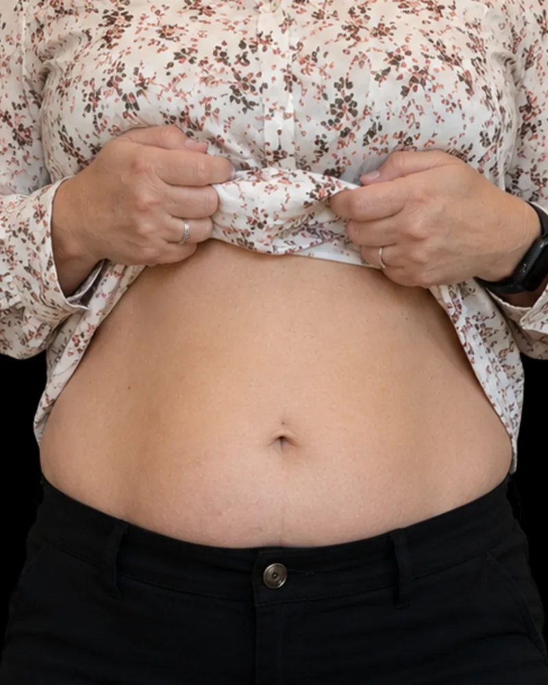 After the BAQ Method, abdomen