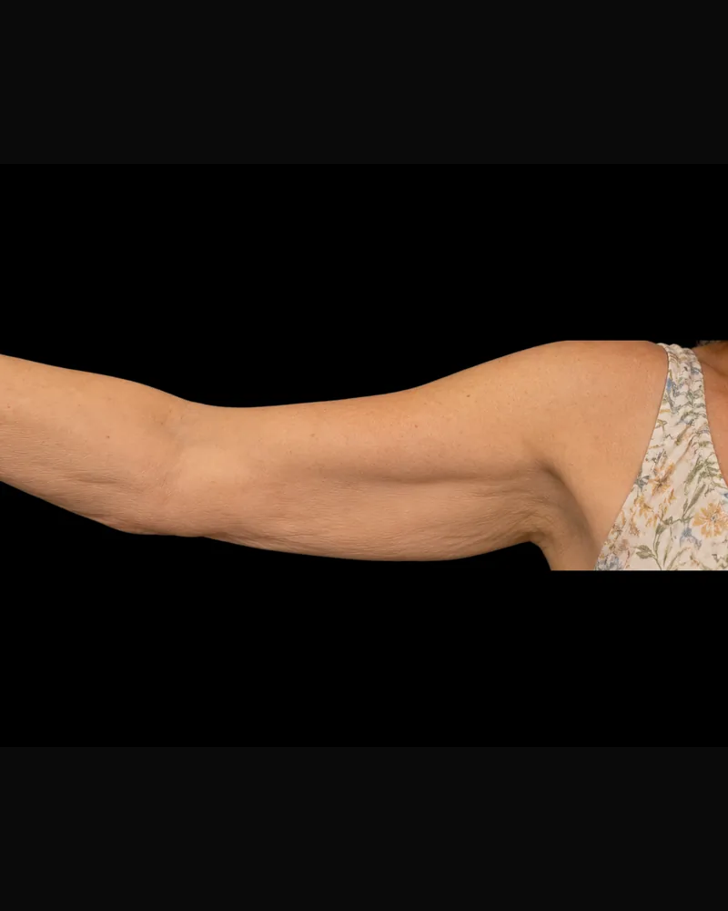 After the BAQ Method, arms