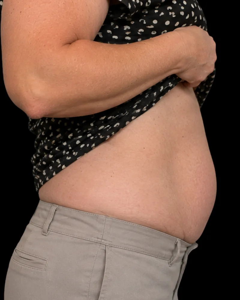 Before body sculpting, abdomen